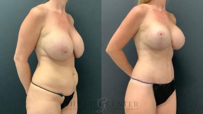 Breast Revisions Case 584 Before & After Right Oblique | The Woodlands, TX | The Gill Center for Plastic Surgery and Dermatology
