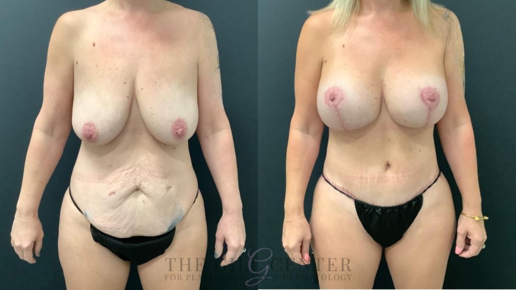 Mommy Makeover Case 590 Before & After Front | The Woodlands, TX | The Gill Center for Plastic Surgery and Dermatology