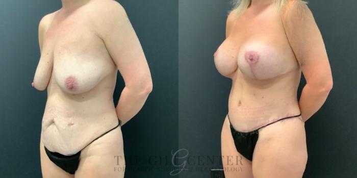 Mommy Makeover Case 590 Before & After Left Oblique | The Woodlands, TX | The Gill Center for Plastic Surgery and Dermatology