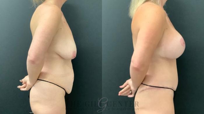 Mommy Makeover Case 590 Before & After Right Side | The Woodlands, TX | The Gill Center for Plastic Surgery and Dermatology