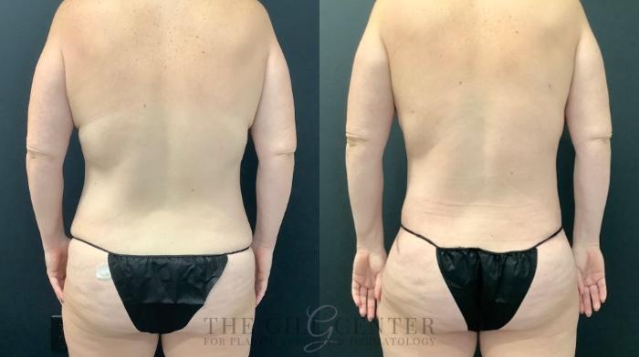 Mommy Makeover Case 594 Before & After Back | The Woodlands, TX | The Gill Center for Plastic Surgery and Dermatology