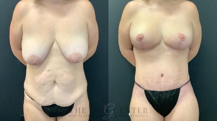 Mommy Makeover Case 594 Before & After Front | The Woodlands, TX | The Gill Center for Plastic Surgery and Dermatology