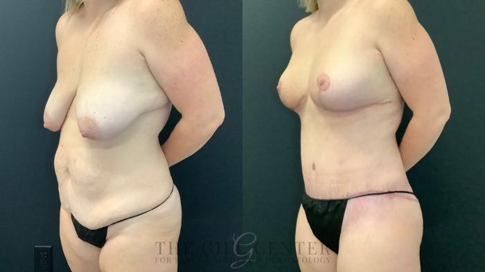 Mommy Makeover Case 594 Before & After Left Oblique | The Woodlands, TX | The Gill Center for Plastic Surgery and Dermatology