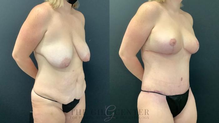 Mommy Makeover Case 594 Before & After Right Oblique | The Woodlands, TX | The Gill Center for Plastic Surgery and Dermatology