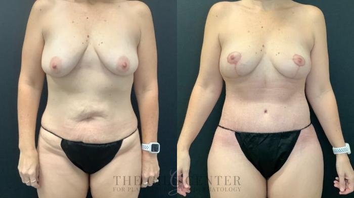 Mommy Makeover Case 597 Before & After Front | The Woodlands, TX | The Gill Center for Plastic Surgery and Dermatology