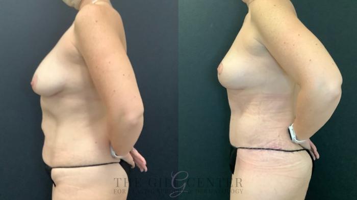 Mommy Makeover Case 597 Before & After Left Oblique | The Woodlands, TX | The Gill Center for Plastic Surgery and Dermatology