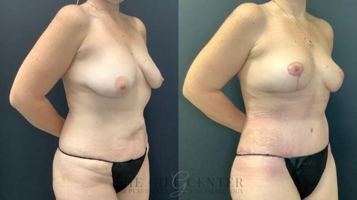 Mommy Makeover Case 597 Before & After Right Oblique | The Woodlands, TX | The Gill Center for Plastic Surgery and Dermatology