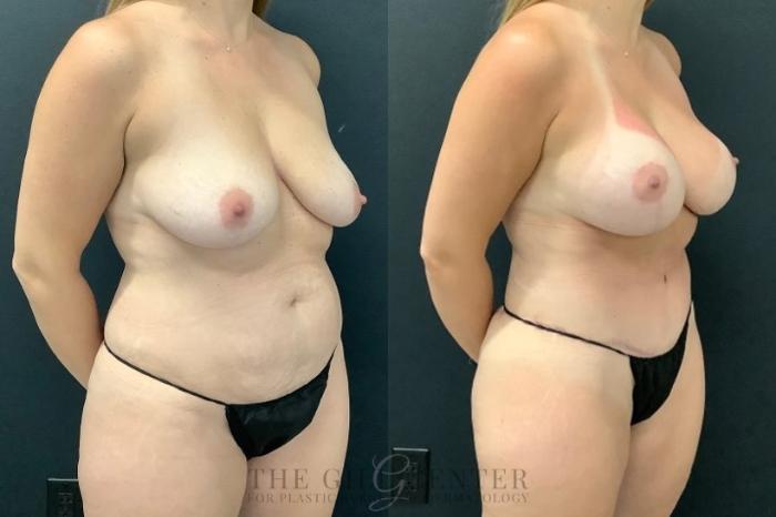 Mommy Makeover Case 604 Before & After Right Oblique | The Woodlands, TX | The Gill Center for Plastic Surgery and Dermatology