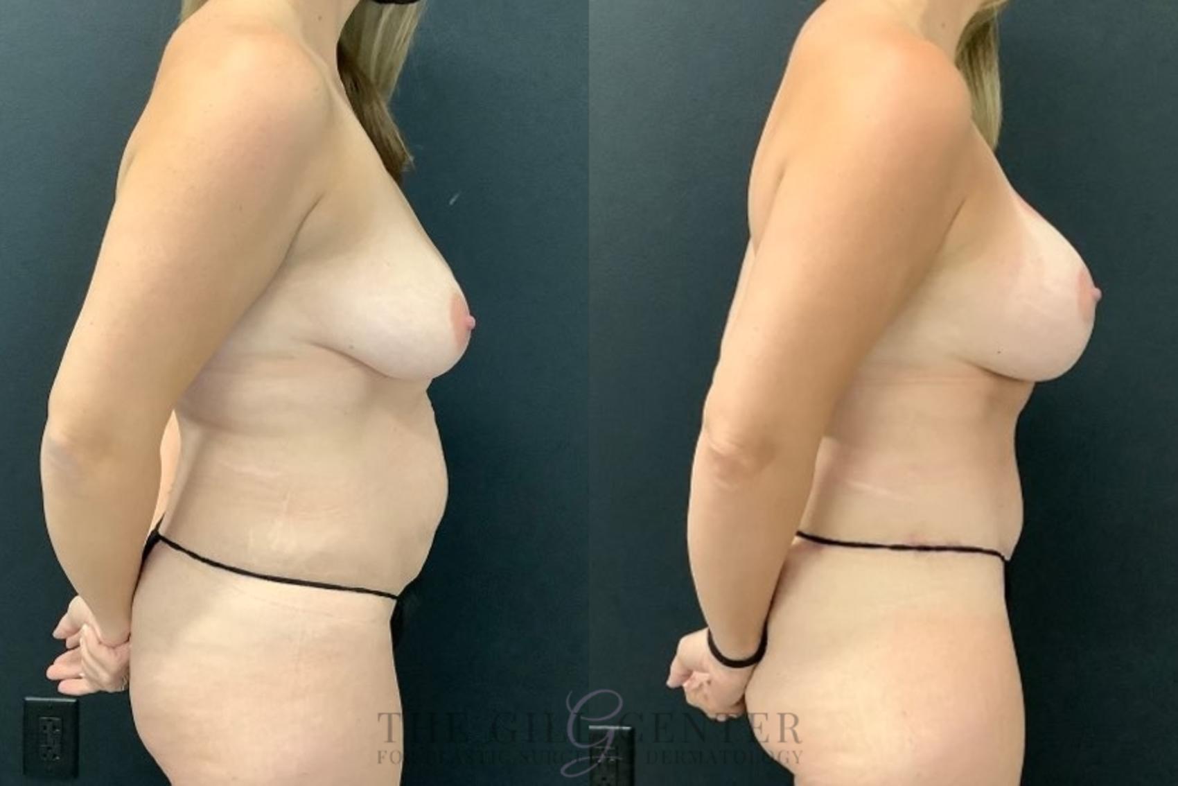 Mommy Makeover Case 604 Before & After Right Side | The Woodlands, TX | The Gill Center for Plastic Surgery and Dermatology