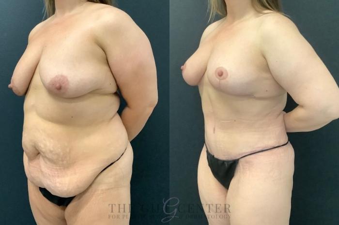 Mommy Makeover Case 607 Before & After Left Oblique | The Woodlands, TX | The Gill Center for Plastic Surgery and Dermatology