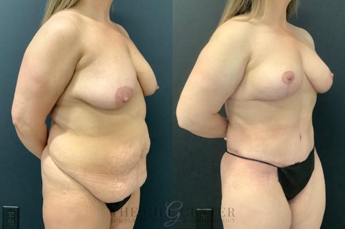 Mommy Makeover Case 607 Before & After Right Oblique | The Woodlands, TX | The Gill Center for Plastic Surgery and Dermatology
