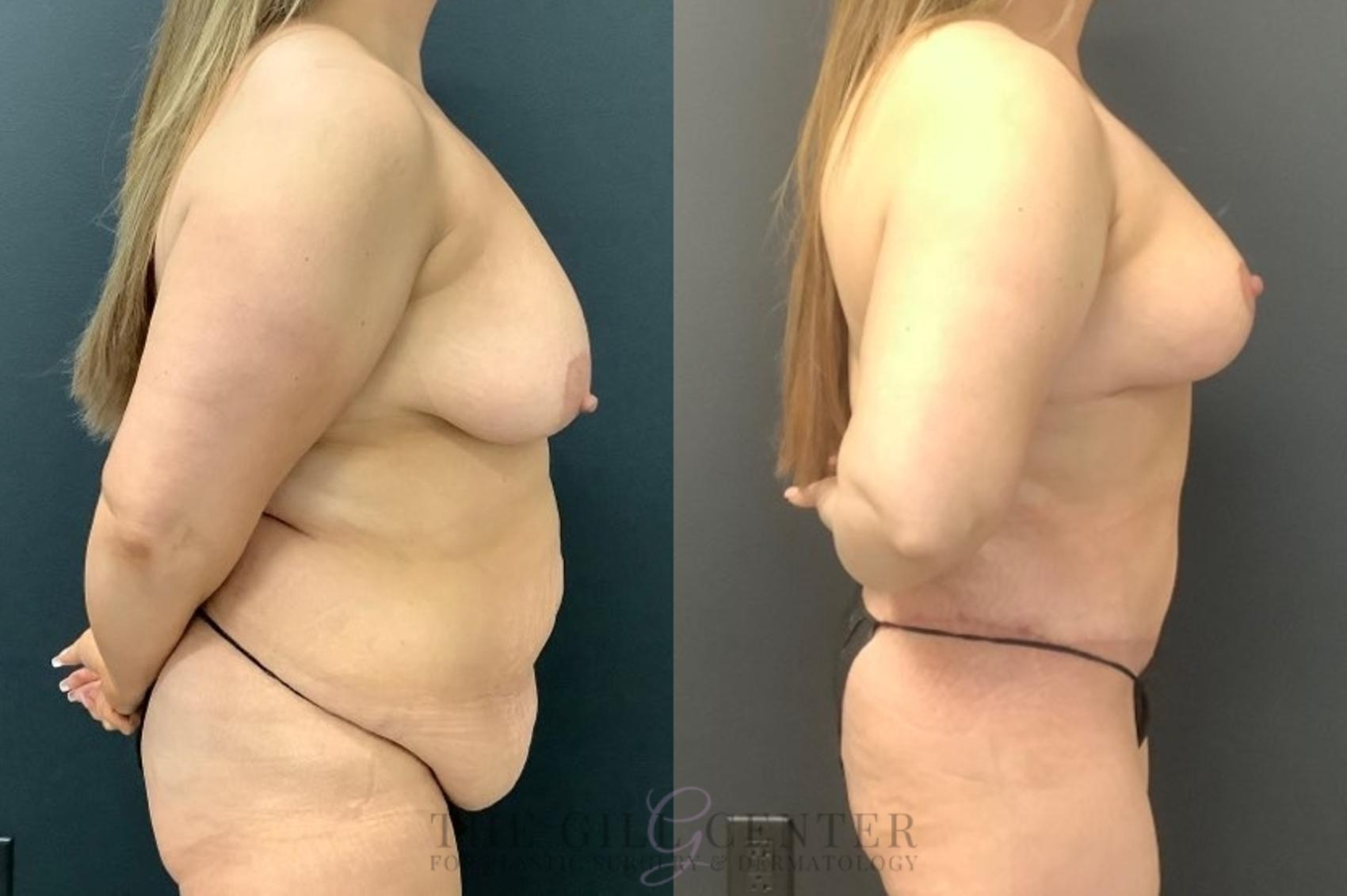 Mommy Makeover Case 607 Before & After Right Side | The Woodlands, TX | The Gill Center for Plastic Surgery and Dermatology