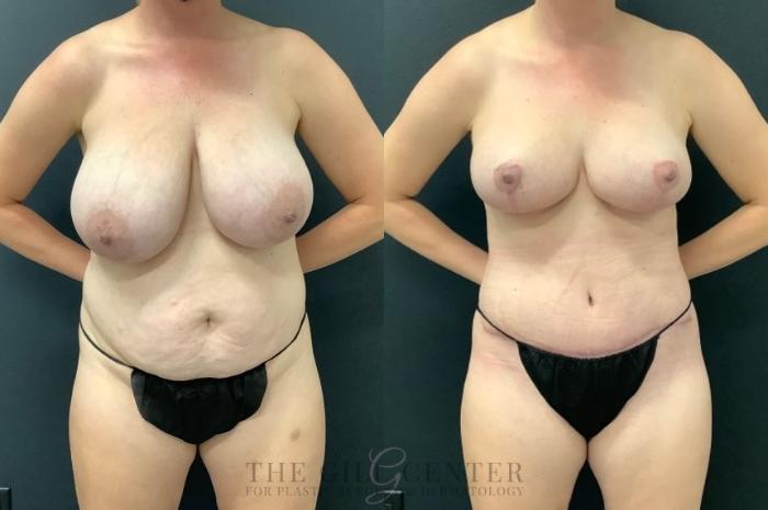 Mommy Makeover Case 608 Before & After Front | The Woodlands, TX | The Gill Center for Plastic Surgery and Dermatology