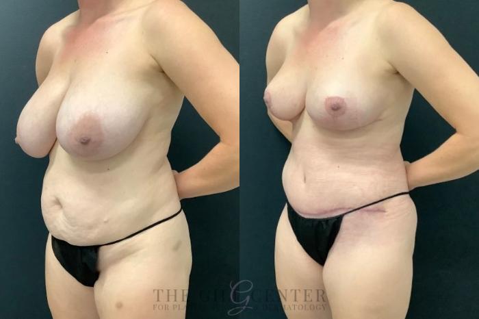 Mommy Makeover Case 608 Before & After Left Oblique | The Woodlands, TX | The Gill Center for Plastic Surgery and Dermatology