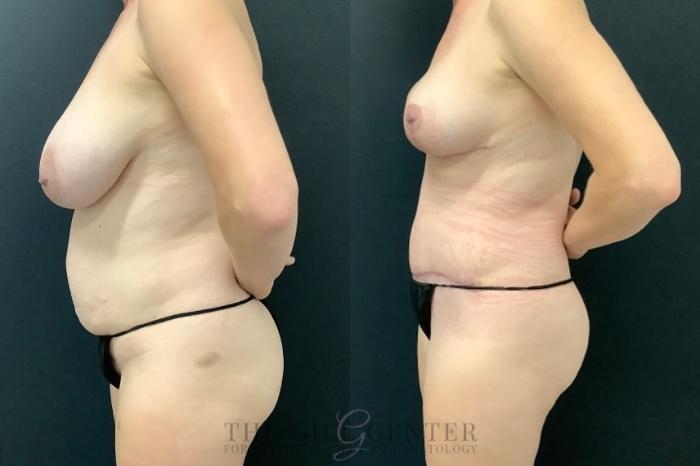 Mommy Makeover Case 608 Before & After Left Side | The Woodlands, TX | The Gill Center for Plastic Surgery and Dermatology