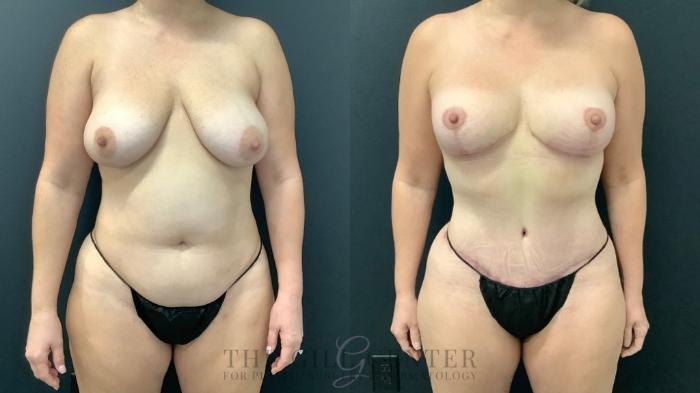 Mommy Makeover Case 612 Before & After Front | The Woodlands, TX | The Gill Center for Plastic Surgery and Dermatology