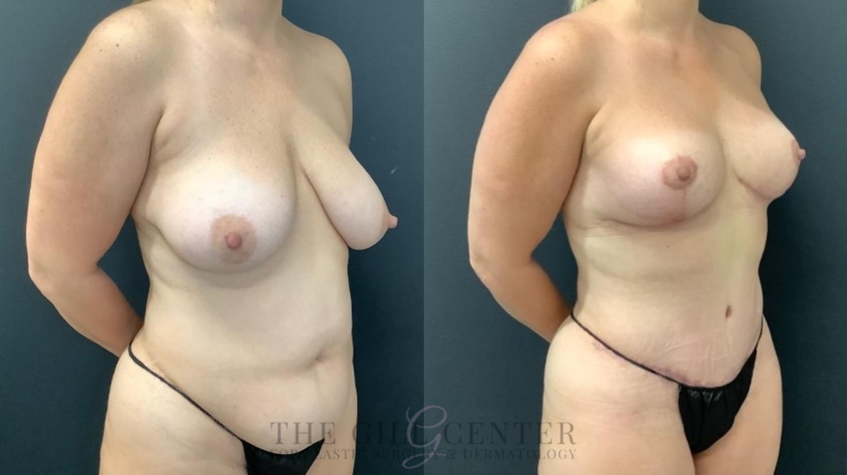 Mommy Makeover Case 612 Before & After Right Oblique | The Woodlands, TX | The Gill Center for Plastic Surgery and Dermatology
