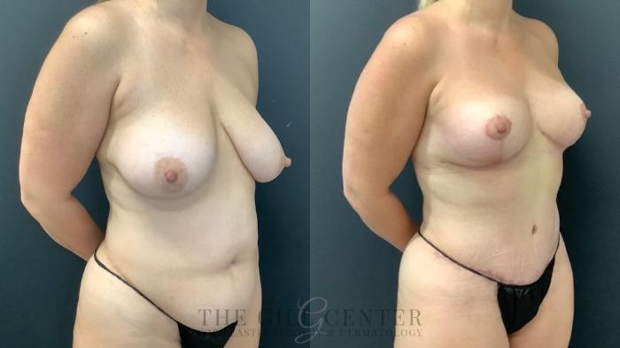 Mommy Makeover Case 612 Before & After Right Oblique | The Woodlands, TX | The Gill Center for Plastic Surgery and Dermatology