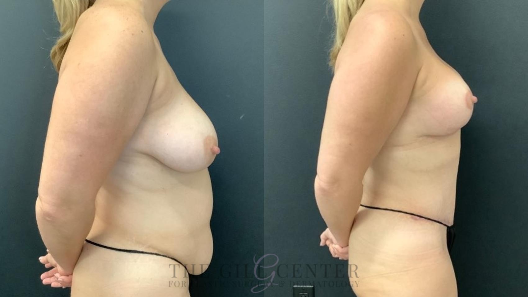Mommy Makeover Case 612 Before & After Right Side | The Woodlands, TX | The Gill Center for Plastic Surgery and Dermatology