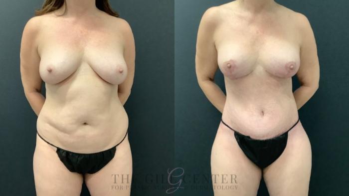 Mommy Makeover Case 615 Before & After Front | The Woodlands, TX | The Gill Center for Plastic Surgery and Dermatology