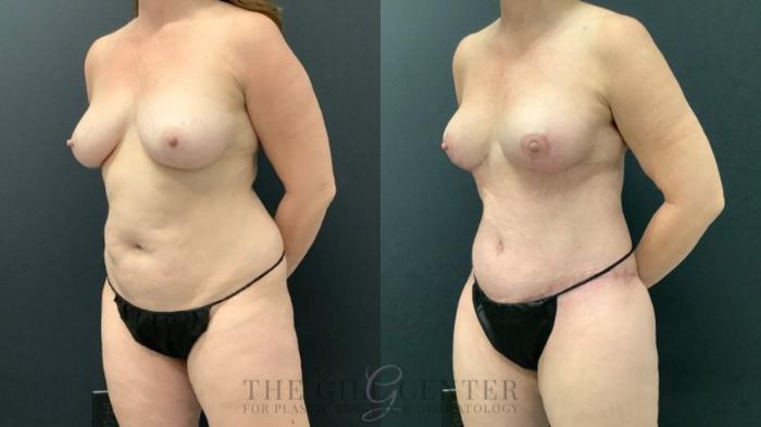 Mommy Makeover Case 615 Before & After Left Oblique | The Woodlands, TX | The Gill Center for Plastic Surgery and Dermatology
