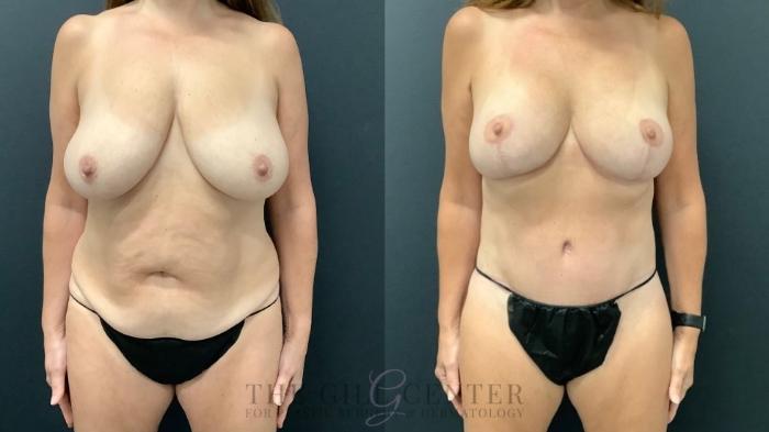 Mommy Makeover Case 617 Before & After Front | The Woodlands, TX | The Gill Center for Plastic Surgery and Dermatology