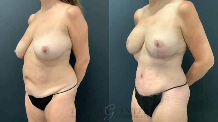 Mommy Makeover Case 617 Before & After Left Oblique | The Woodlands, TX | The Gill Center for Plastic Surgery and Dermatology
