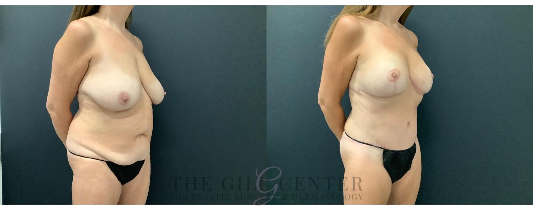 Mommy Makeover Case 617 Before & After Right Oblique | The Woodlands, TX | The Gill Center for Plastic Surgery and Dermatology