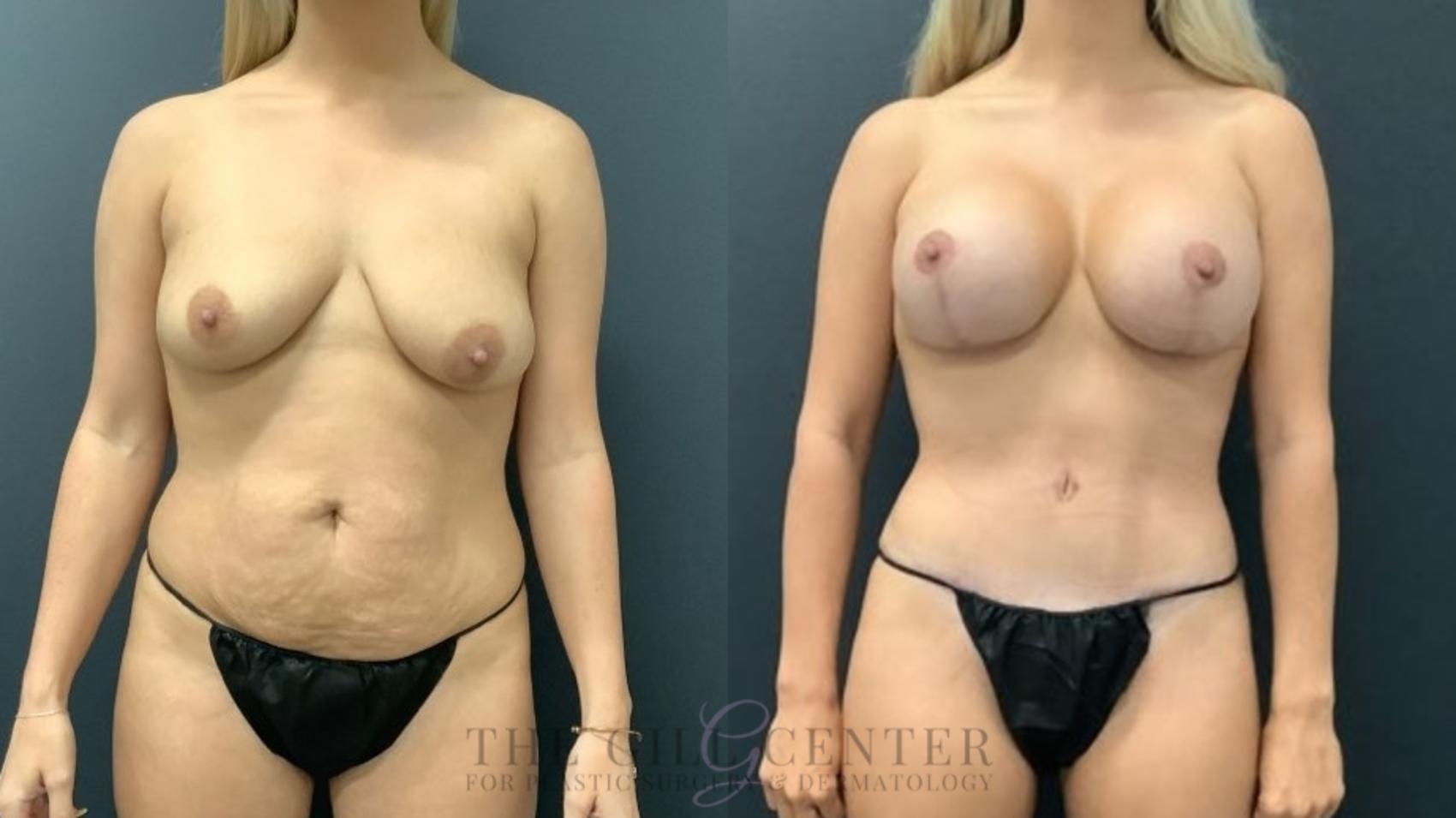 Mommy Makeover Case 621 Before & After Front | The Woodlands, TX | The Gill Center for Plastic Surgery and Dermatology