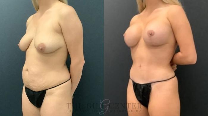 Mommy Makeover Case 621 Before & After Left Oblique | The Woodlands, TX | The Gill Center for Plastic Surgery and Dermatology