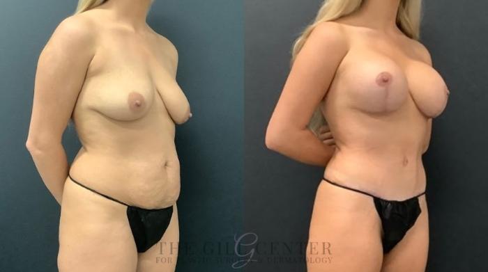 Mommy Makeover Case 621 Before & After Right Oblique | The Woodlands, TX | The Gill Center for Plastic Surgery and Dermatology