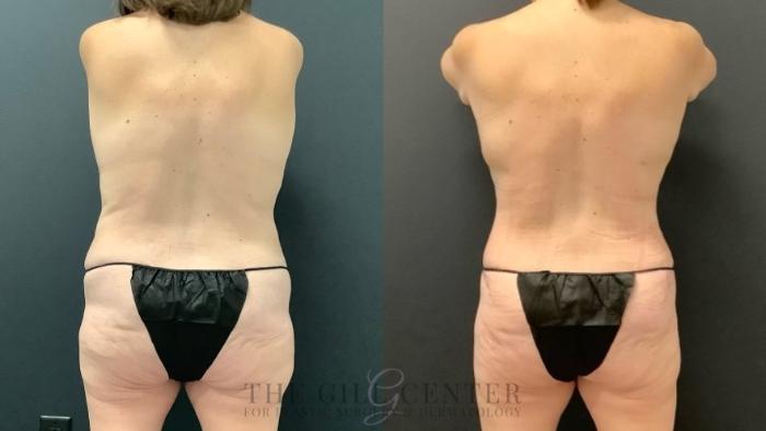 Mommy Makeover Case 627 Before & After Back | The Woodlands, TX | The Gill Center for Plastic Surgery and Dermatology