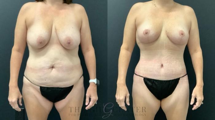 Mommy Makeover Case 627 Before & After Front | The Woodlands, TX | The Gill Center for Plastic Surgery and Dermatology