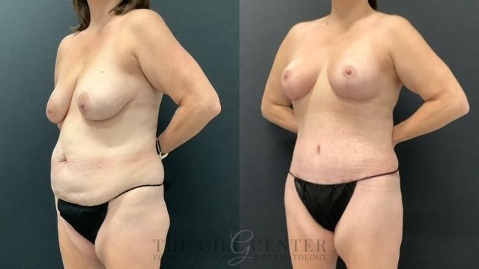 Mommy Makeover Case 627 Before & After Left Oblique | The Woodlands, TX | The Gill Center for Plastic Surgery and Dermatology