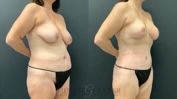 Mommy Makeover Case 627 Before & After Right Oblique | The Woodlands, TX | The Gill Center for Plastic Surgery and Dermatology