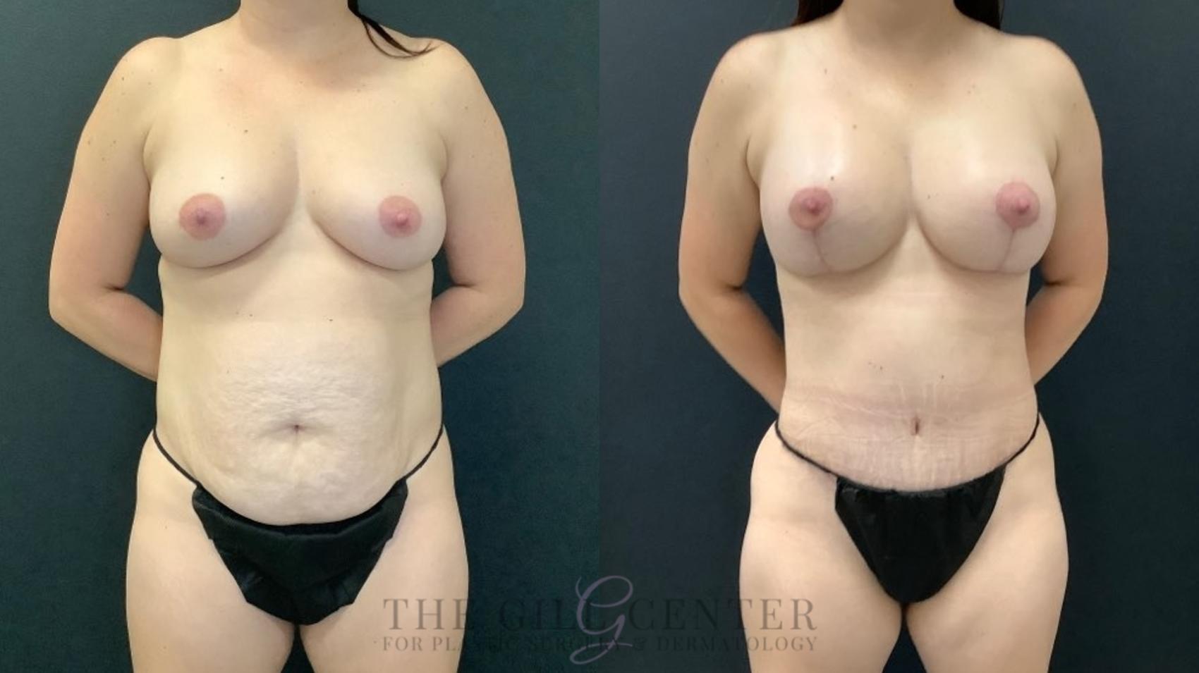 Mommy Makeover Case 634 Before & After Front | The Woodlands, TX | The Gill Center for Plastic Surgery and Dermatology