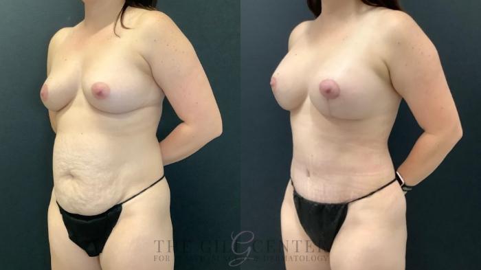 Mommy Makeover Case 634 Before & After Left Oblique | The Woodlands, TX | The Gill Center for Plastic Surgery and Dermatology