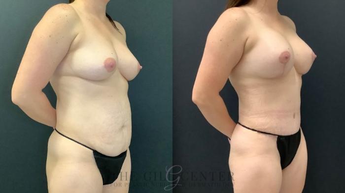 Mommy Makeover Case 634 Before & After Right Oblique | The Woodlands, TX | The Gill Center for Plastic Surgery and Dermatology