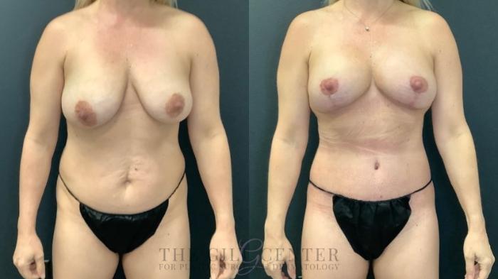 Mommy Makeover Case 651 Before & After Front | The Woodlands, TX | The Gill Center for Plastic Surgery and Dermatology