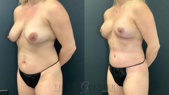 Mommy Makeover Case 651 Before & After Left Oblique | The Woodlands, TX | The Gill Center for Plastic Surgery and Dermatology