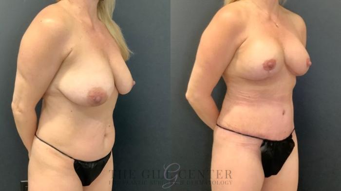Mommy Makeover Case 651 Before & After Right Oblique | The Woodlands, TX | The Gill Center for Plastic Surgery and Dermatology