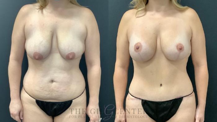 Mommy Makeover Case 652 Before & After Front | The Woodlands, TX | The Gill Center for Plastic Surgery and Dermatology