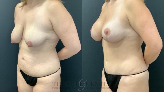 Mommy Makeover Case 652 Before & After Left Oblique | The Woodlands, TX | The Gill Center for Plastic Surgery and Dermatology