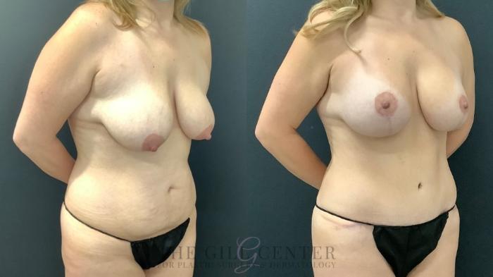 Mommy Makeover Case 652 Before & After Right Oblique | The Woodlands, TX | The Gill Center for Plastic Surgery and Dermatology