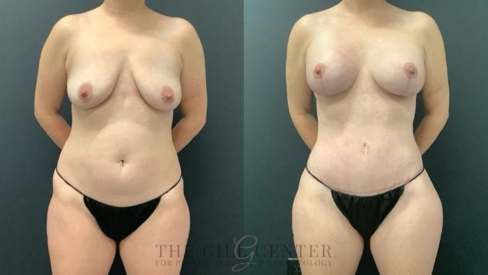 Mommy Makeover Case 655 Before & After Front | The Woodlands, TX | The Gill Center for Plastic Surgery and Dermatology