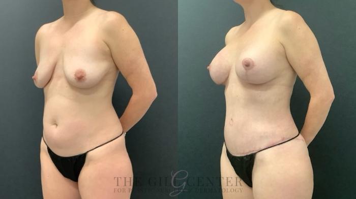 Mommy Makeover Case 655 Before & After Right Oblique | The Woodlands, TX | The Gill Center for Plastic Surgery and Dermatology