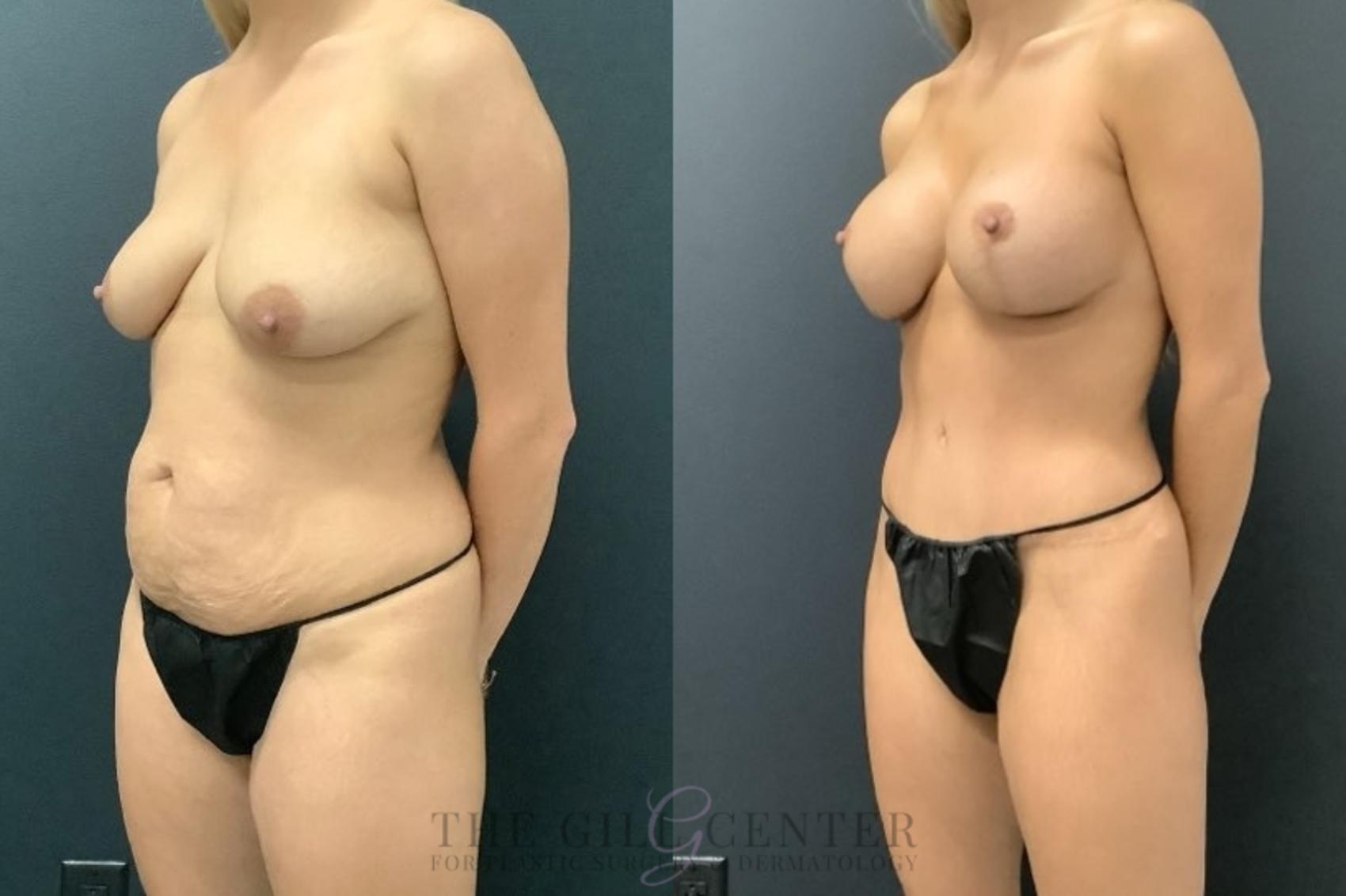 Mommy Makeover Case 665 Before & After Left | The Woodlands, TX | The Gill Center for Plastic Surgery and Dermatology