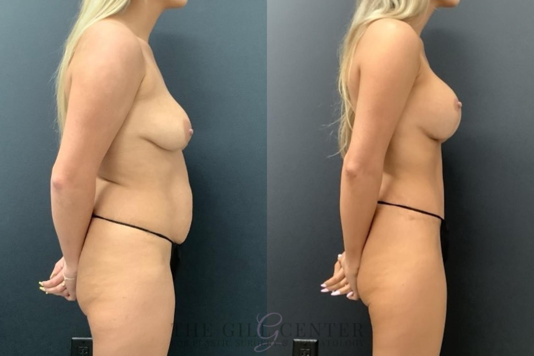Mommy Makeover Case 665 Before & After Right Side | The Woodlands, TX | The Gill Center for Plastic Surgery and Dermatology