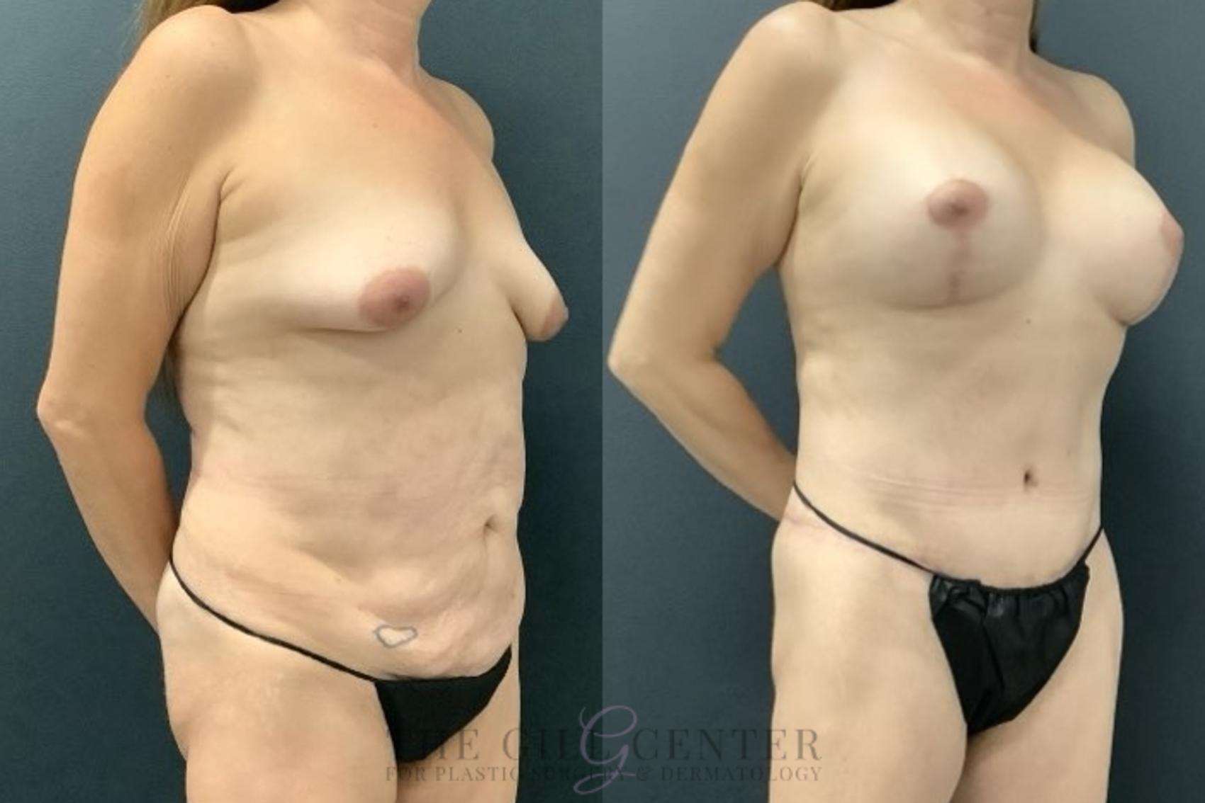 Mommy Makeover Case 669 Before & After Right Side | The Woodlands, TX | The Gill Center for Plastic Surgery and Dermatology