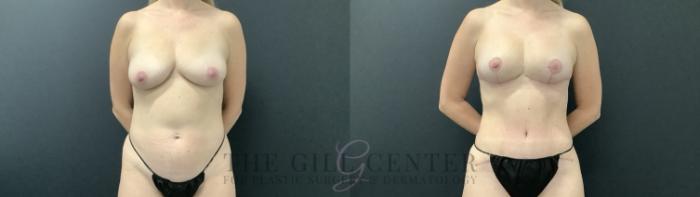 Mommy Makeover Case 686 Before & After Front | The Woodlands, TX | The Gill Center for Plastic Surgery and Dermatology